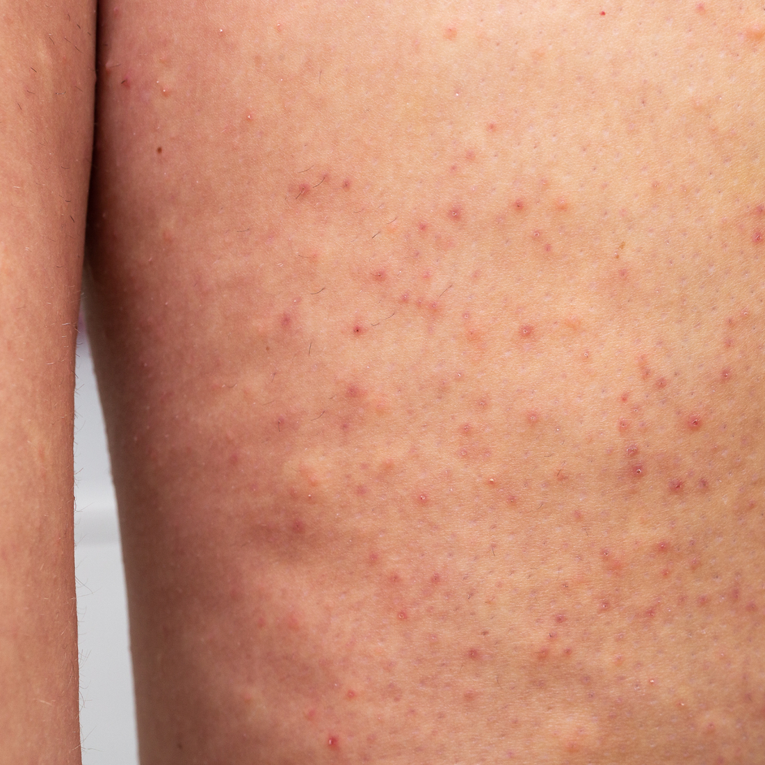 KP & frottements : pourquoi vos vêtements influencent la texture de votre peau