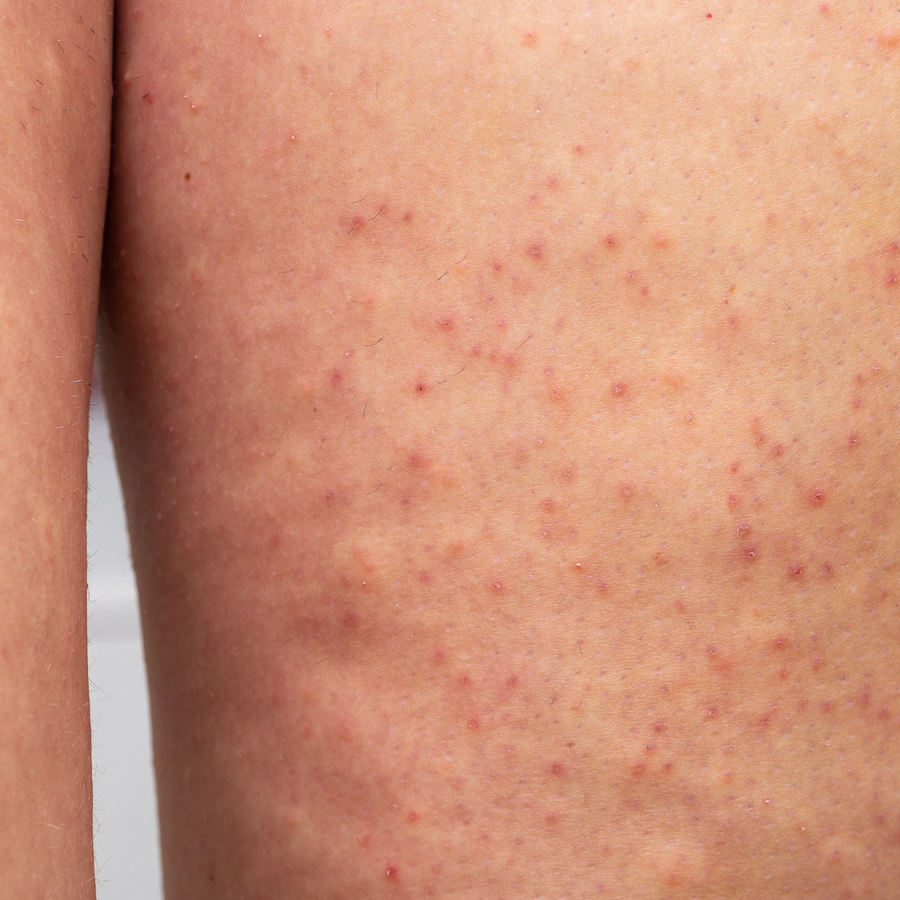 KP & frottements : pourquoi vos vêtements influencent la texture de votre peau